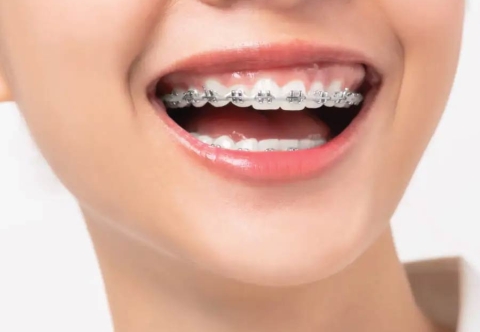 Niềng răng hô nhẹ! Có nên niềng răng hô nhẹ không?